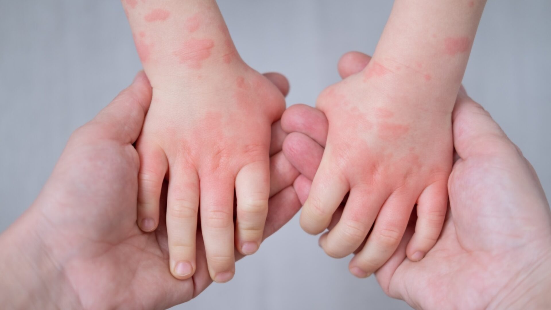 Scratching and crying: the visible signs of eczema