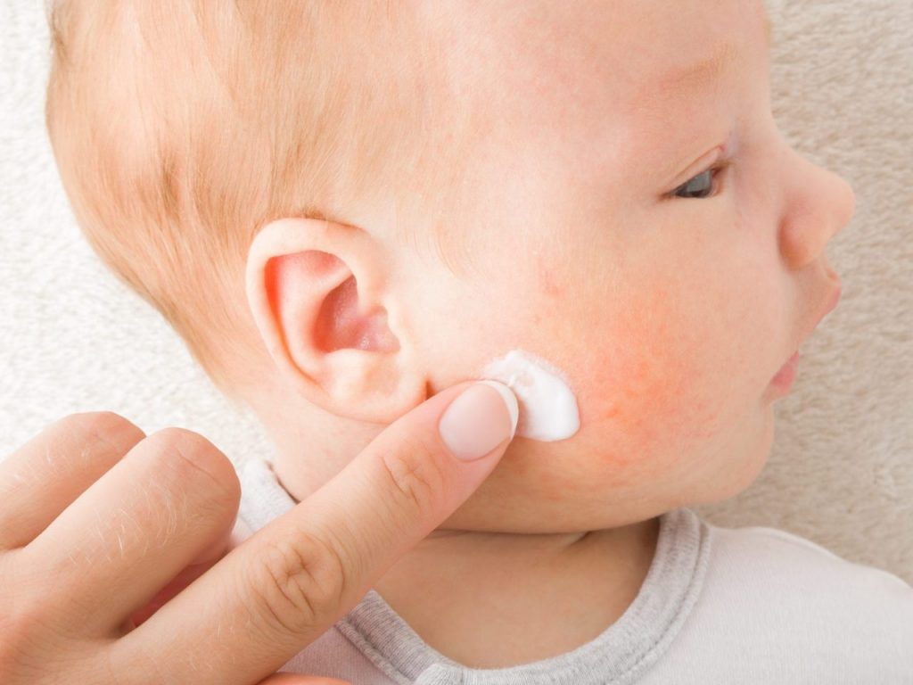 The 6 golden tips to reduce eczema in your baby
